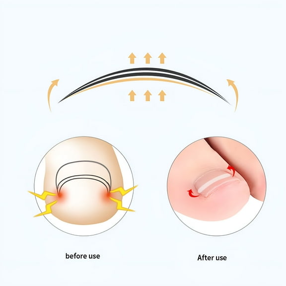 QARUN 10pcs Ingrown Toenail Treatment Correction Elastic Patch Sticker