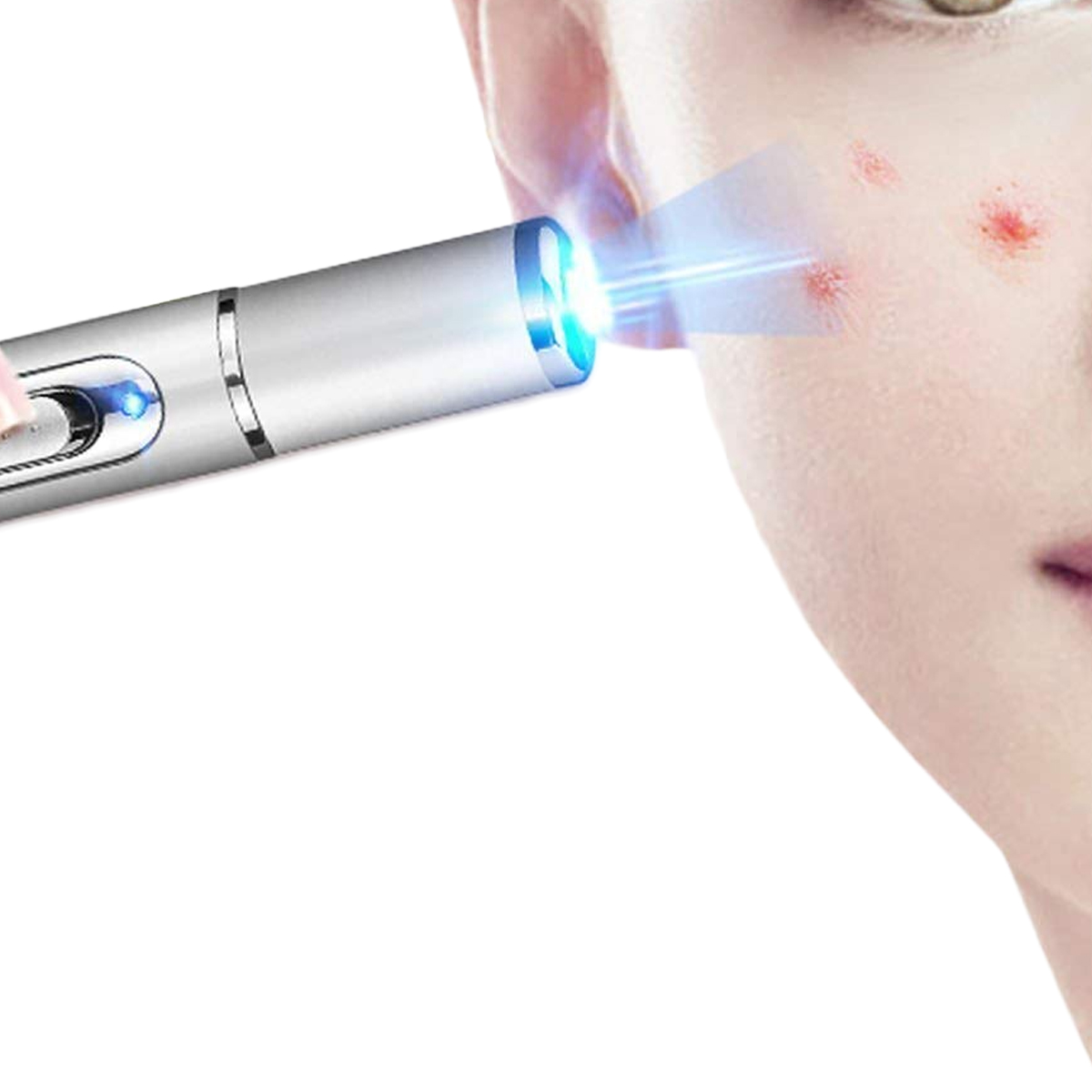 RUEWEY Medical Blue Light Therapy Laser Treatment Pen Acne Skin Care Device - image 1 of 5