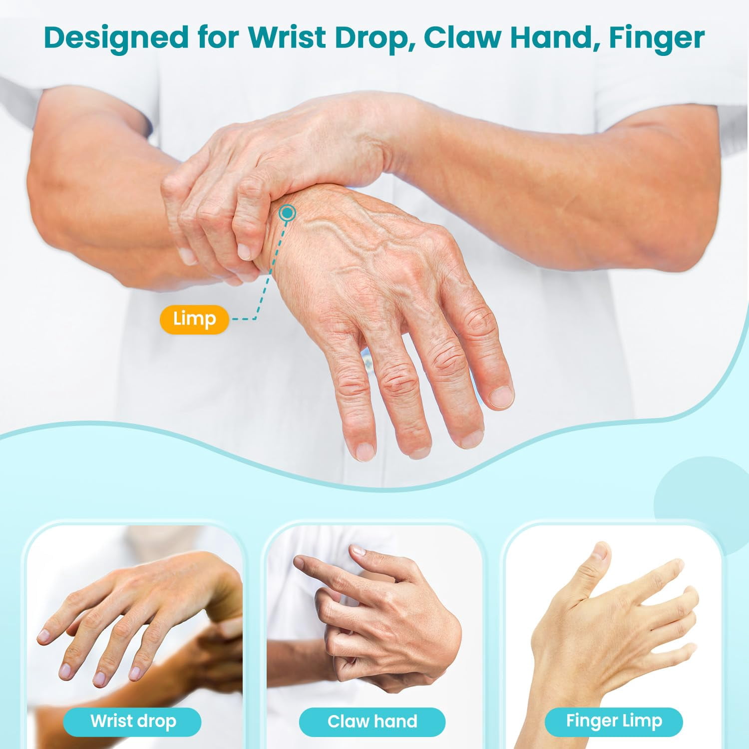 Rnp Splint Radial Nerve Palsy Splint Brace for Wrist Drop - 5 Finger Extension ...