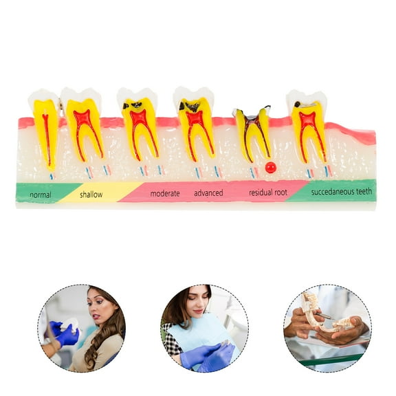 SHOWERORO Oral Education Tooth Model Teeth Model Multi 1Pack Patient Explanation