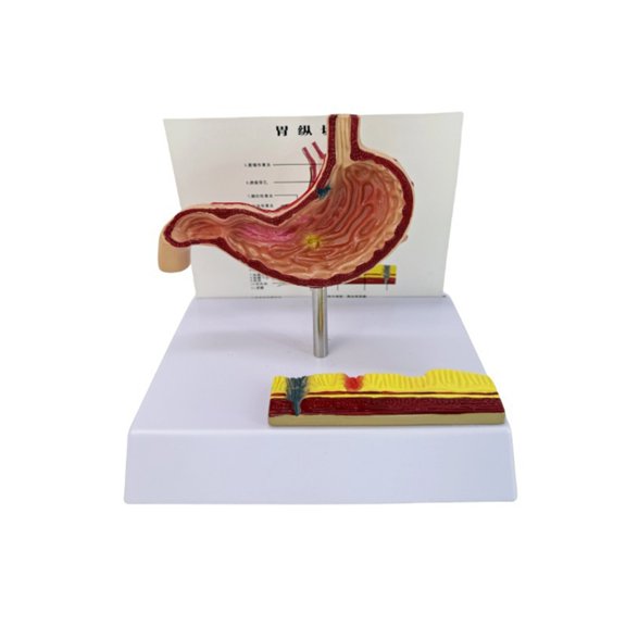Realistic Gastric Perforation Anatomy Model Pathological Stomach Anatomy Model for Teaching Research Clinical Settings