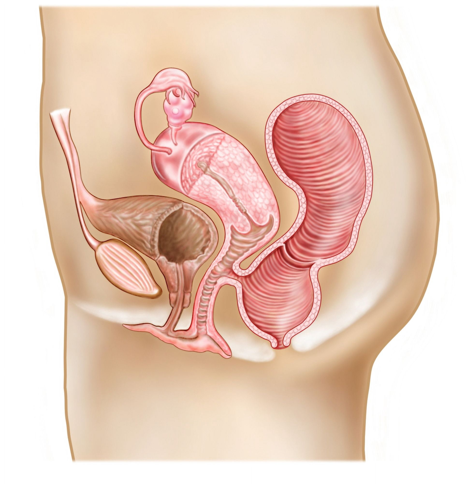 Rectovaginal fistula and cross section of female reproductive organs Canvas Art - Stocktrek Images (27 x 28)