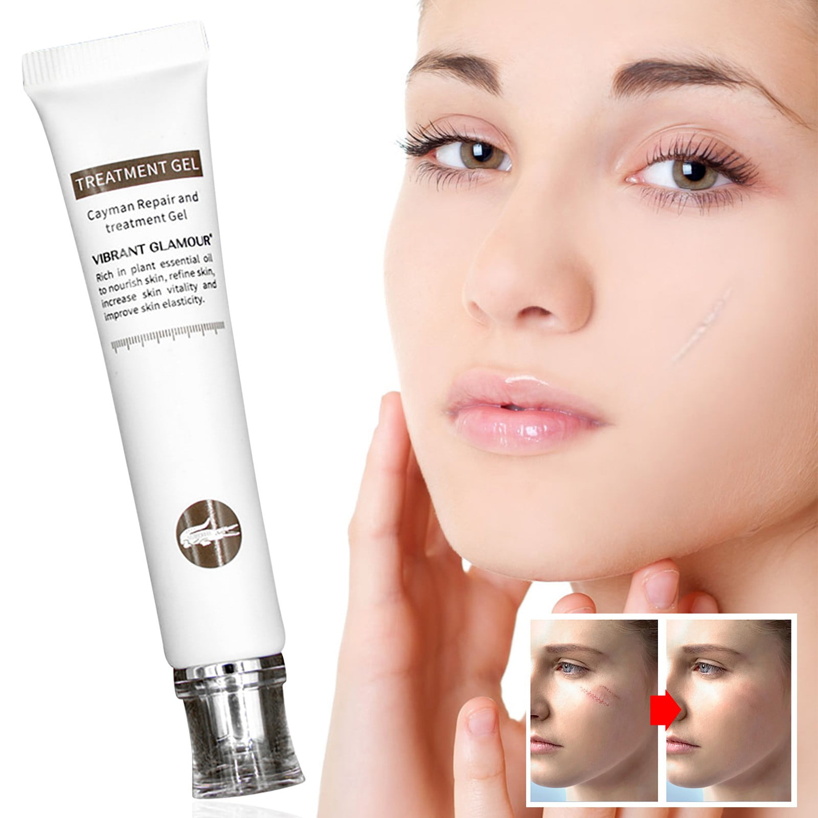 Removal Gel, AntiAcne Cream, Stretch Mark Cream, Effectively Fade Acne