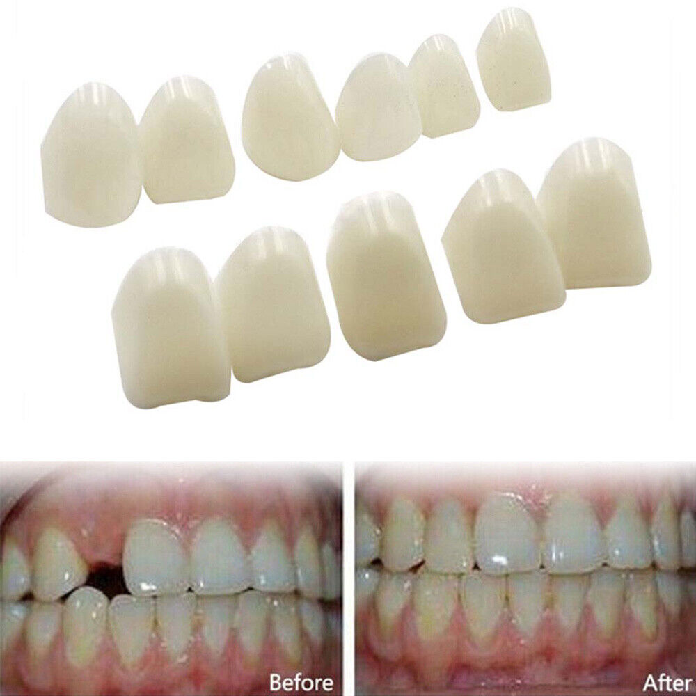 Resin Posteriors Anterior Molar Tooth Cap Dental Practical Temporary