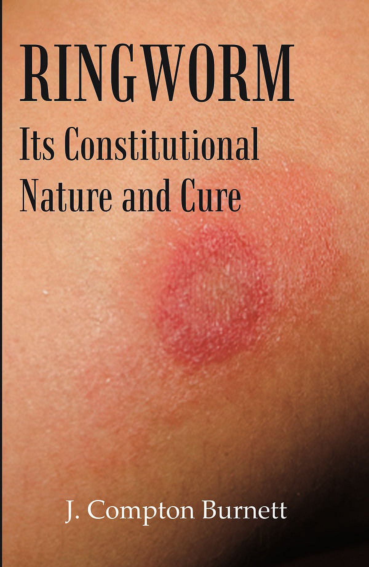Ringworm Its Constitutional Nature and Cure