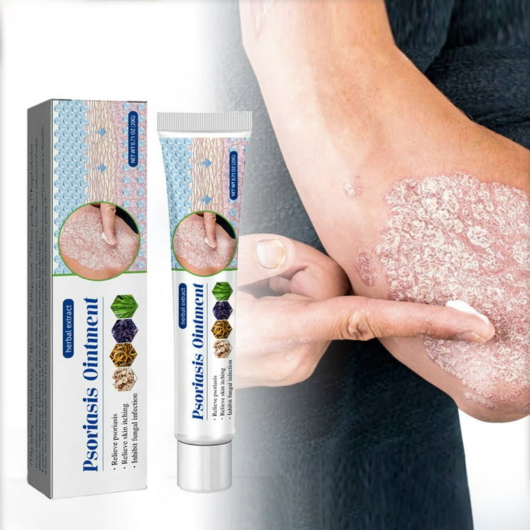 ringworm in humans