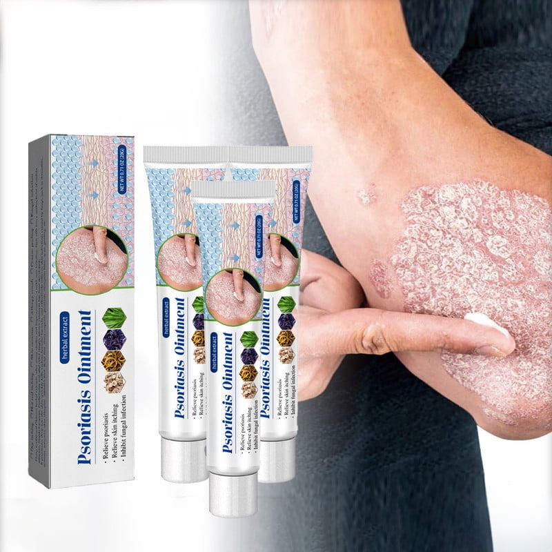 Ringworm Treatment For humans，Tinea Versicolor Treatment, Antifungal