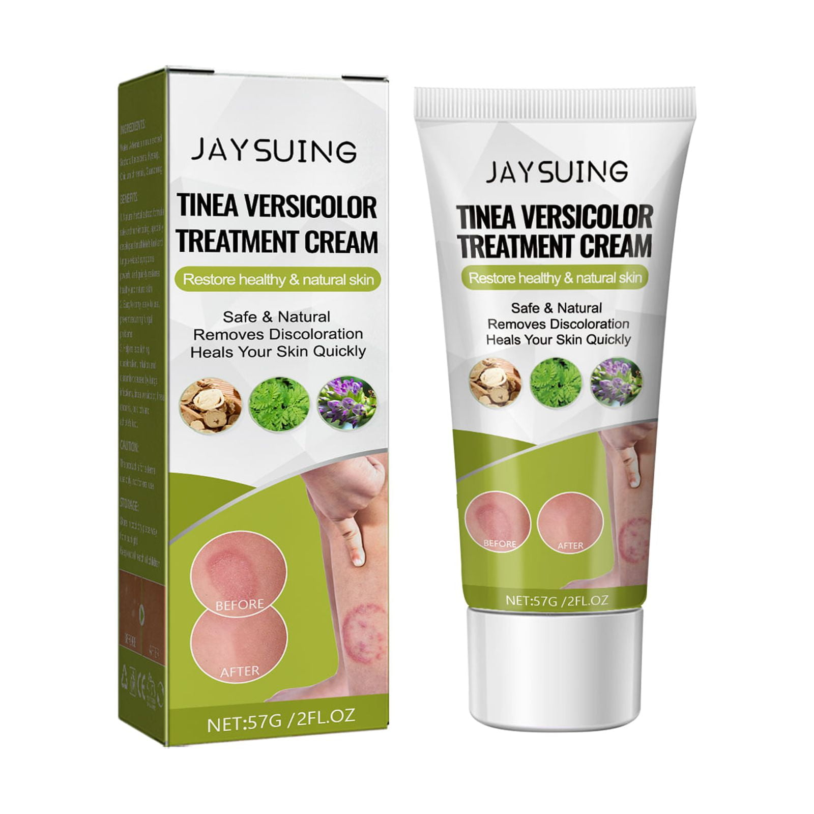Roycederm Tinea Versicolor Treatment, Antifungal Cream for Tinea Versicolor  & Pedis, Athletes Foot Treatment, Ringworm Treatment For humans, Fast  healing Anti Fungal Skin Cream 