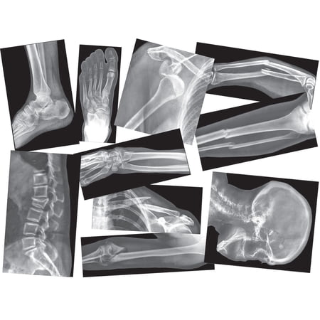 Roylco Broken Bones X-Rays – Human Skeletal Fracture X-Ray Set for STEM/STEAM Anatomy Lessons, Light Table Viewing & Hands-On Science Learning
