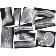 Roylco Broken Bones X-Rays   Human Skeletal Fracture X-Ray Set for STEM/STEAM Anatomy Lessons, Light Table Viewing & Hands-On Science Learning