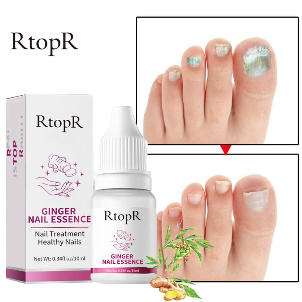 RtopR Ginger Antibacterial Nail Treatment Antifungal Nail Toe Fungus