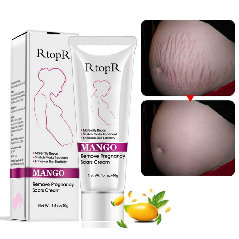 RtopR Mango Stretch Marks and Scar Cream -Stretch Marks and Scar Removal  Cream for Pregnancy - Best Body Moisturizer-40g 