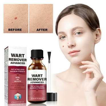 STAOEDU Clearance Deals! Exclusive That Quickly Plantar Warts and Common Warts. Safe, Natural and Effective,20ML
