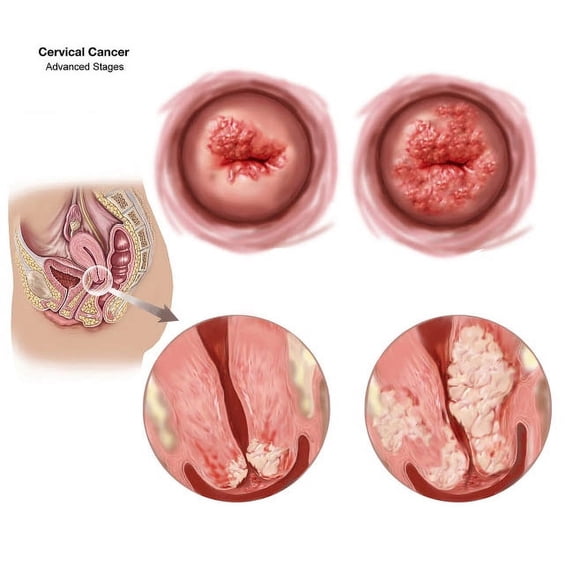 Sagittal view and vaginal view of advanced cervical cancer Poster Print by TriFocal Communications/Stocktrek Images (16