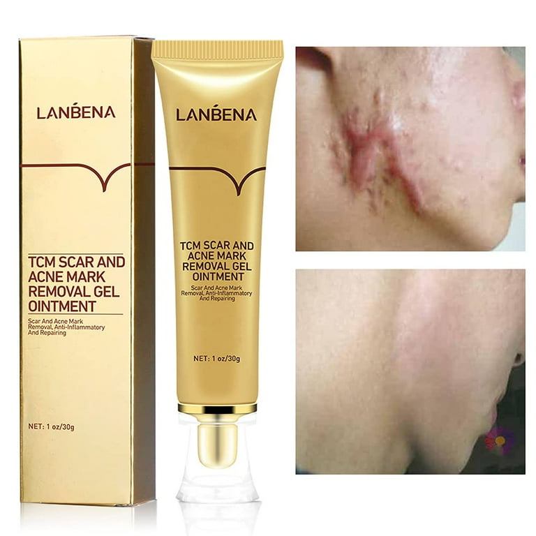 Acne scar removal products deals