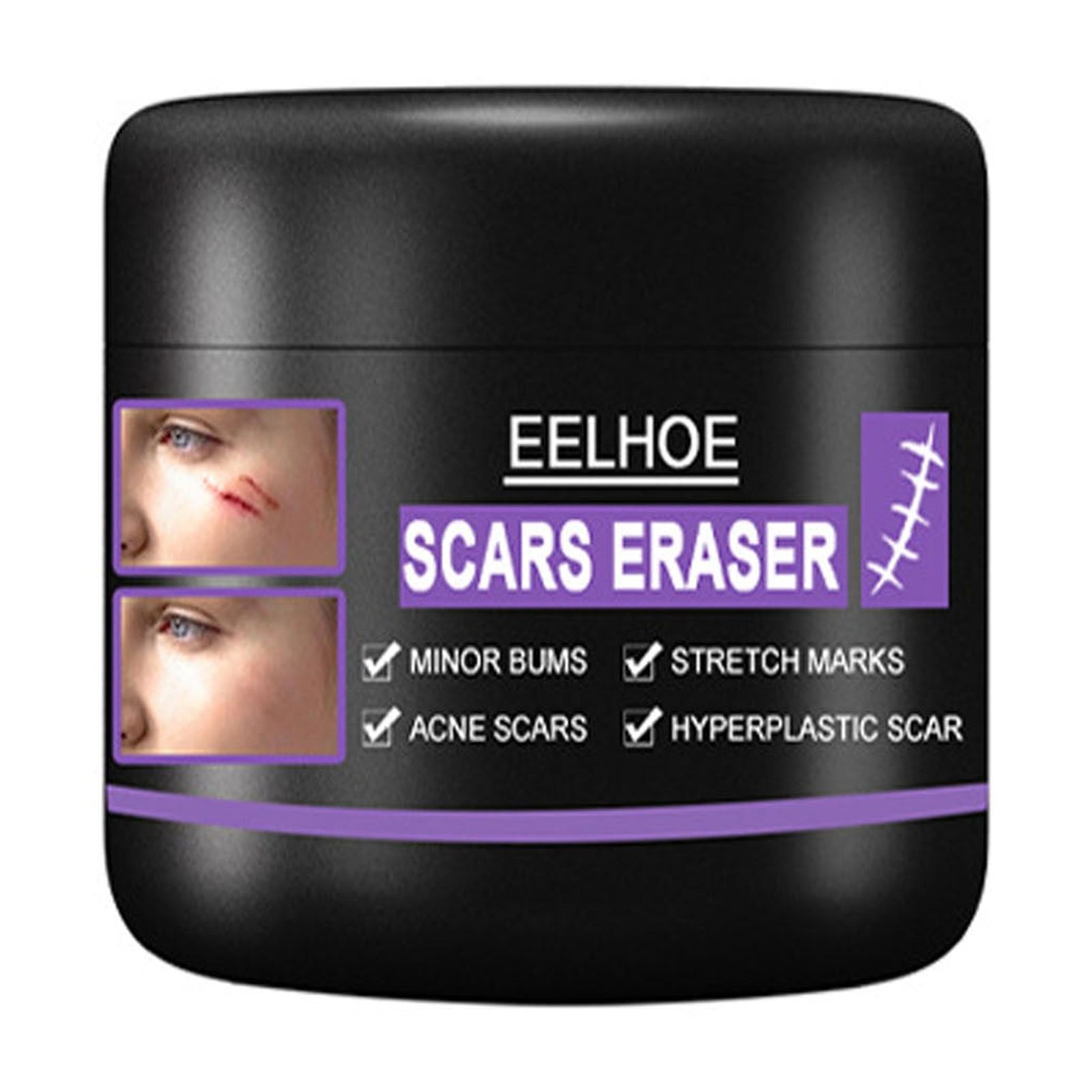 Scar Removal Cream Stretch Marks Relief And Burns Repair Acne Mark Removal Cream