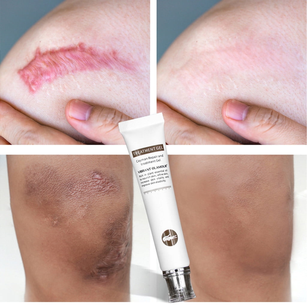 The Best Ways To Get Rid of Acne Scars