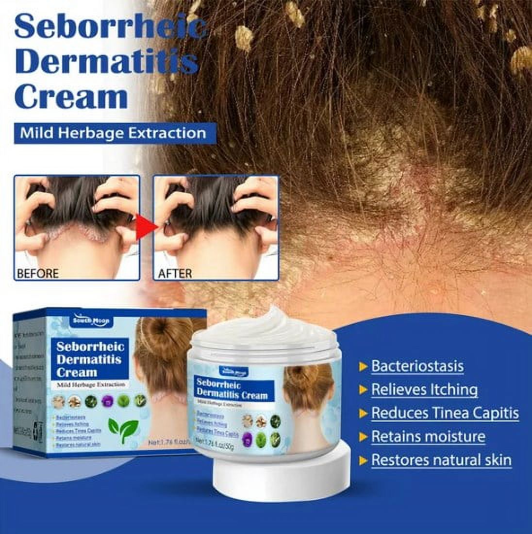 Seborrheic Dermatitis Cream, Psoriasis Cream, Scalp Treatment for