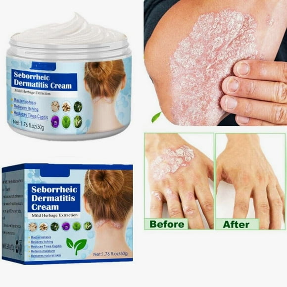 Seborrheic Dermatitis Soap