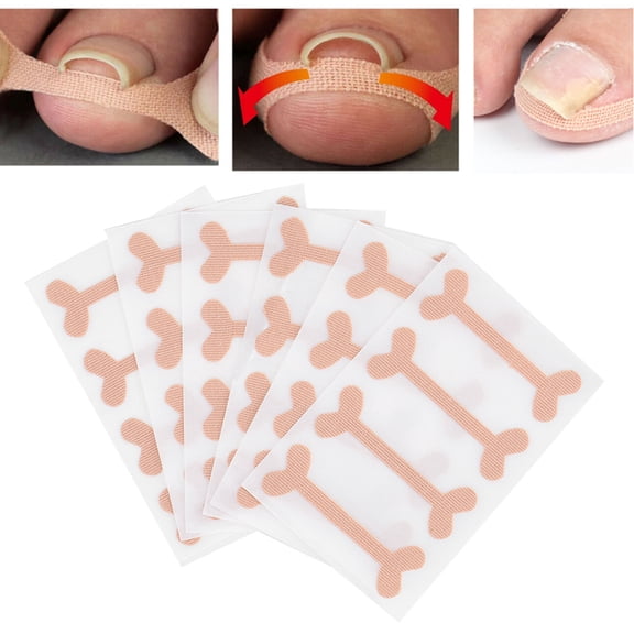 Senjay Ingrown Nail Correction Bandage, 24Pcs Ingrown Toenail Stick Patch,For Paronychia Toe