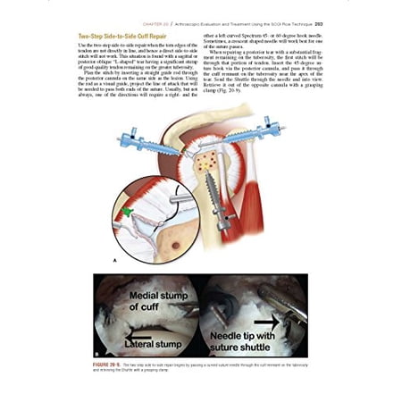 Pre-Owned Shoulder Arthroscopy (Hardcover)