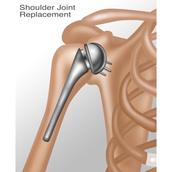 Shoulder Joint Replacement, Illustration Poster Print by Gwen Shockey/Science Source (18 x 24)
