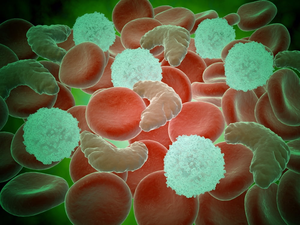 Sickle cell anemia with red blood cells and white bood cells Canvas Art - Stocktrek Images (33 x 25)
