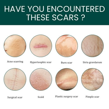Silicone Scar Sheets (1.6" x 60" Roll-1.5M),Silicone Scar Tape Roll,Scar Silicone Strips,Reusable,Professional Scar Removal Sheets for C-Section,Surgery,Burn,Keloid,Acne et