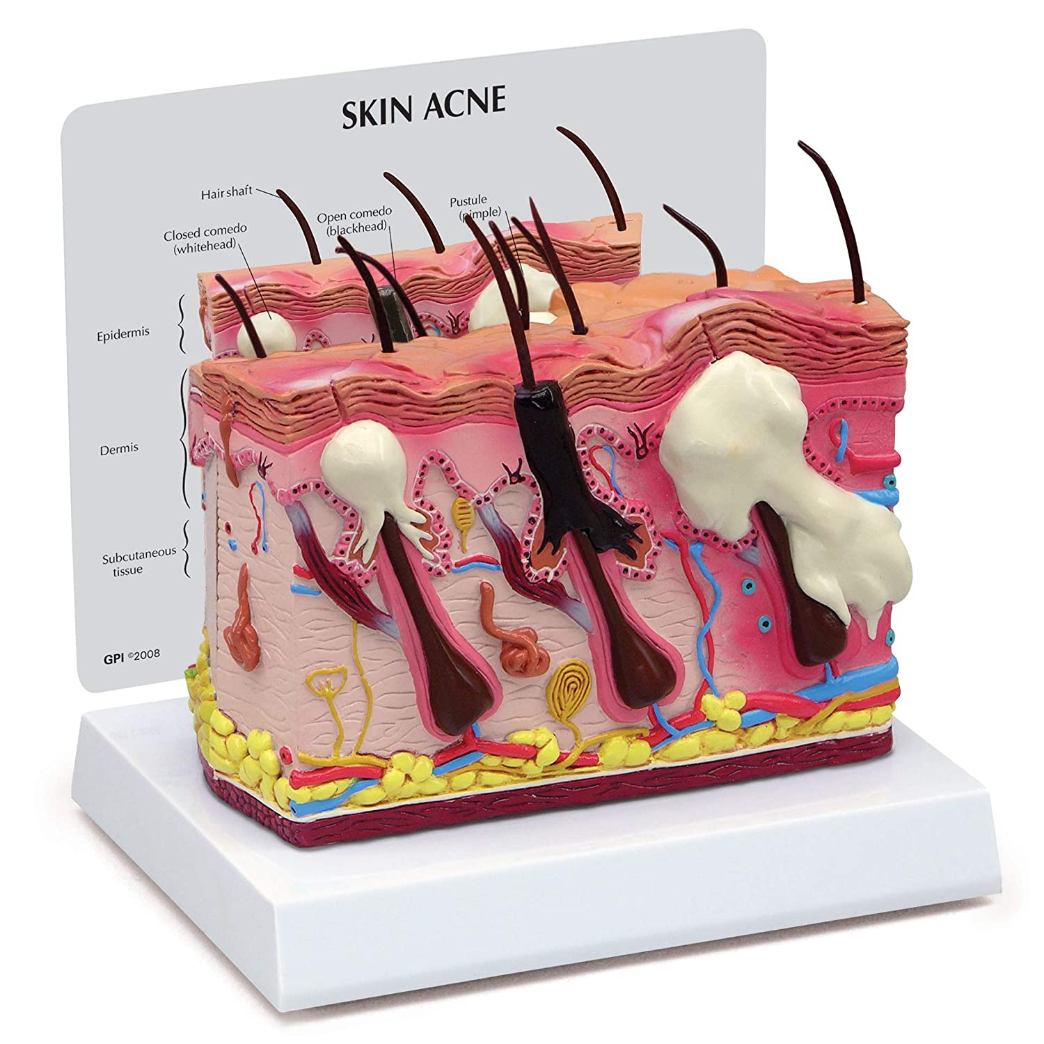 Skin Acne Model Cross Section Showing Normal And Liberia Ubuy