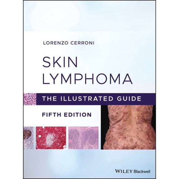Skin Lymphoma, (Hardcover)
