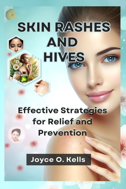 Prevent Skin Rashes Skin Rashes and Hives: Effective Strategies for Relief and Prevention ...