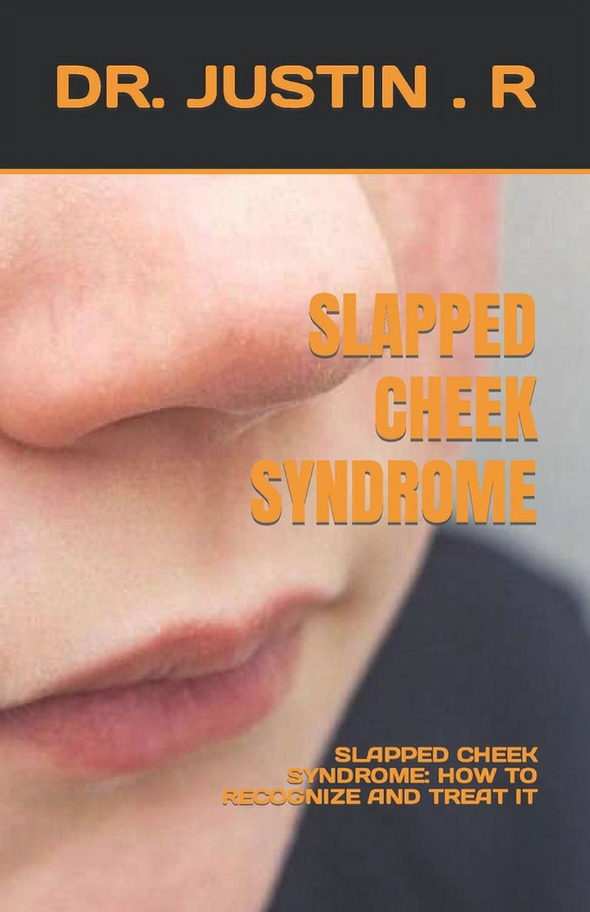 Slabbed Check Slapped Cheek Syndrome : Slapped Cheek Syndrome: How to Recognize and ...