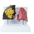 thumbnail image 1 of Smokers Lung Model, Healthy Lung Model Life Size Human Lung Anatomy Model with Pathological Features, 1 of 8