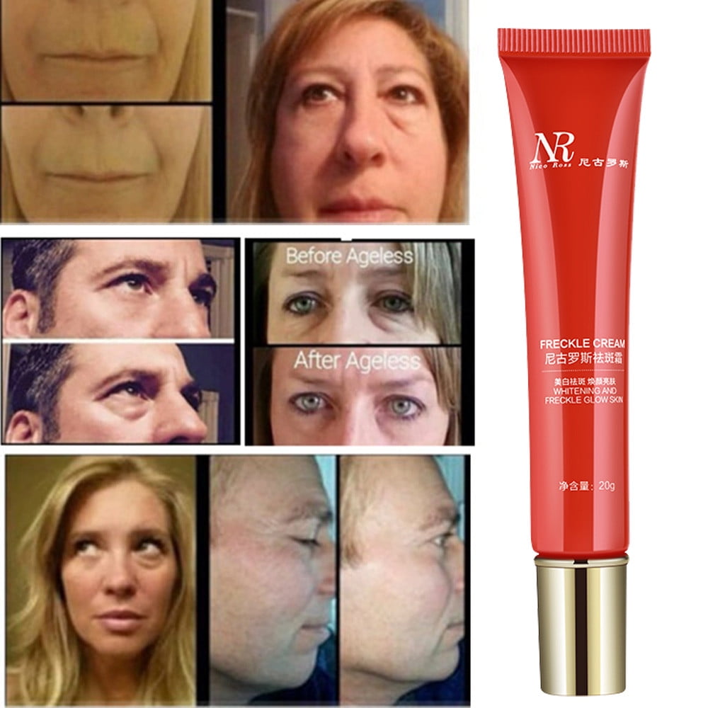 Soft Cream Anti Extract Acne Removal Scars Marks Treatment Facial 20g