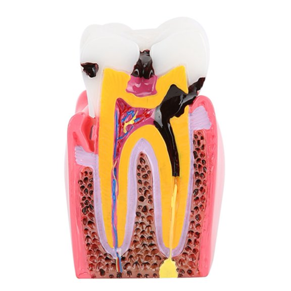 Sorven Caries Teeth Model Anatomy Model, Resin Teeth Model for Oral Care for Laboratory