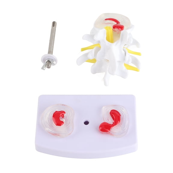 Sorven Lumbar Model Lumbar Model, Human Spine Model Mounted Securely with 2 Diseased Intervertebral Discs for School