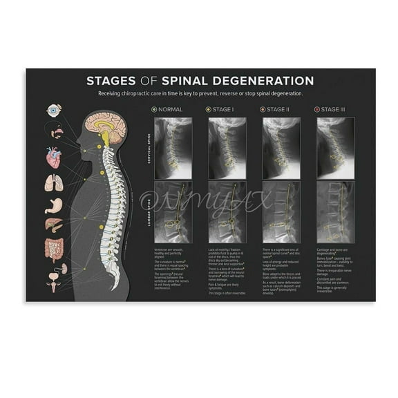 Spinal Degeneration Level Chart Demonstration Chart Spinal Subluxation Art Poster (3) Canvas Poster Bedroom Decor Office Room Decor Gift