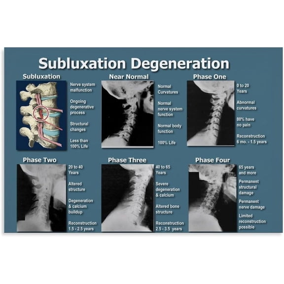 Spinal Degeneration Nerve Subluxation Chart (3) Canvas Print Wall-Art Decoration Living Room Office Bedroom