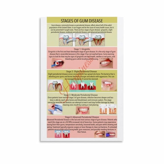 Stages of Gum Disease Poster Periodontal Disease Educational Dental Health Wall Art Canvas Painting Posters And Prints Wall Art for Living Room Bedroom Decor