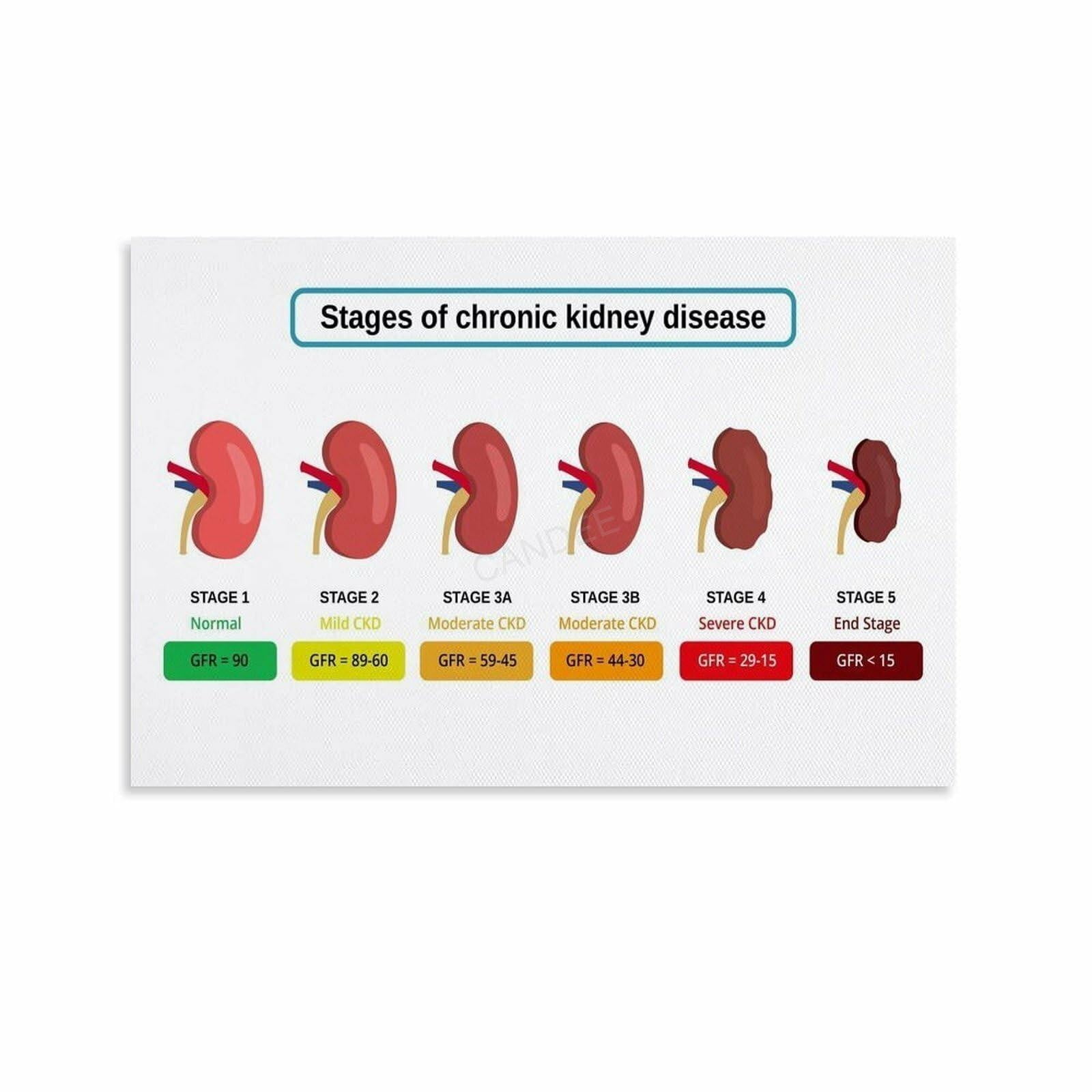 Kidney Function Guid Stages of Kidney Disease Guide Poster Infographic (13) - Walmart.com