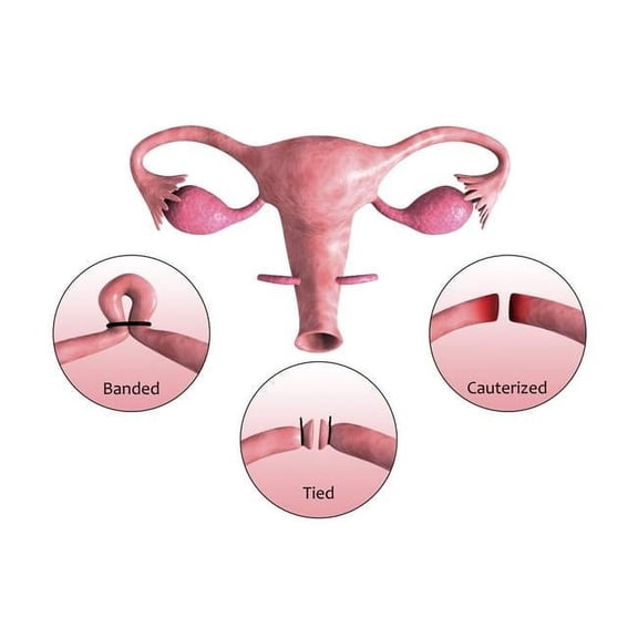 StockTrek Images  Biomedical Illustration of A Tubectomy. A Tubectomy is When A Womans Fallopian Tubes Are Blocked To Prevent Implantation of Eggs Poster Print, 35 x 23 - Large