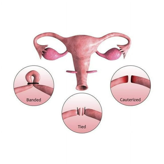 StockTrek Images PSTSTK701226HLARGE Biomedical Illustration of A Tubectomy. A Tubectomy is When A Womans Fallopian Tubes Are Blocked To Prevent Implantation of Eggs Poster Print, 35 x 23 - Large