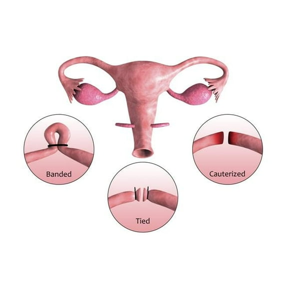 StockTrek Images PSTSTK701226HLARGE Biomedical Illustration of A Tubectomy. A Tubectomy is When A Womans Fallopian Tubes Are Blocked To Prevent Implantation of Eggs Poster Print, 35 x 23 - Large