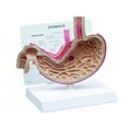 thumbnail image 1 of Stomach with Ulcers Model, 1 of 1