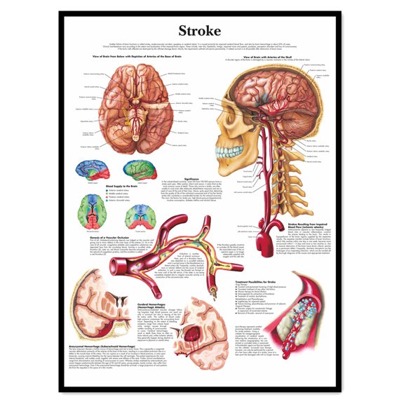 Stroke Medical Poster Wall Art - Human Anatomy Picture Chart Body Structure Decor, Unframed Gallery Canvas Print Painting Home Decor for Office Home Living Room Classroom,White,11.8X16.5 inch
