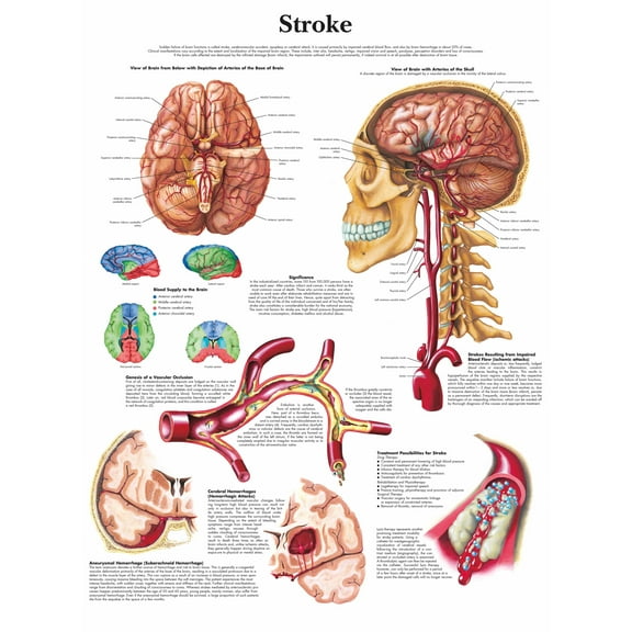 Stroke Wall Art Posters Canvas Print Artwork Wall Chart Human Anatomy Wall Painting Office Hospital Room Home Decoration (without Framed),Multicolor