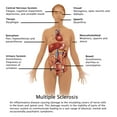 thumbnail image 1 of Symptoms of Multiple Sclerosis Poster Print by Gwen Shockey/Science Source (24 x 24), 1 of 1