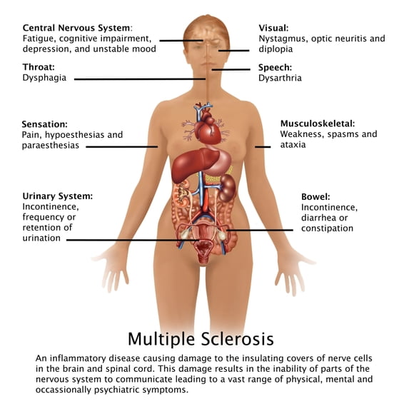 Symptoms of Multiple Sclerosis Poster Print by Gwen Shockey/Science Source (24 x 24)