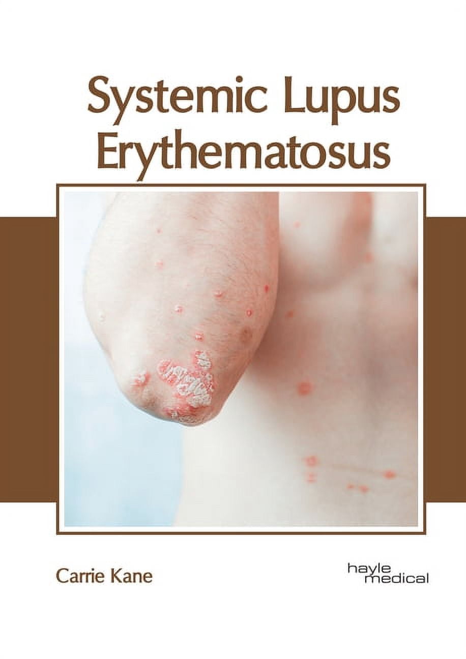 Sle Rash Textbook Systemic Lupus Erythematosus, (Hardcover) - Walmart.com