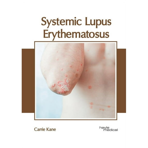 Systemic Lupus Erythematosus, (Hardcover)